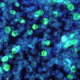 En verde, células de leucemia infectadas por el virus Epstein-Barr.